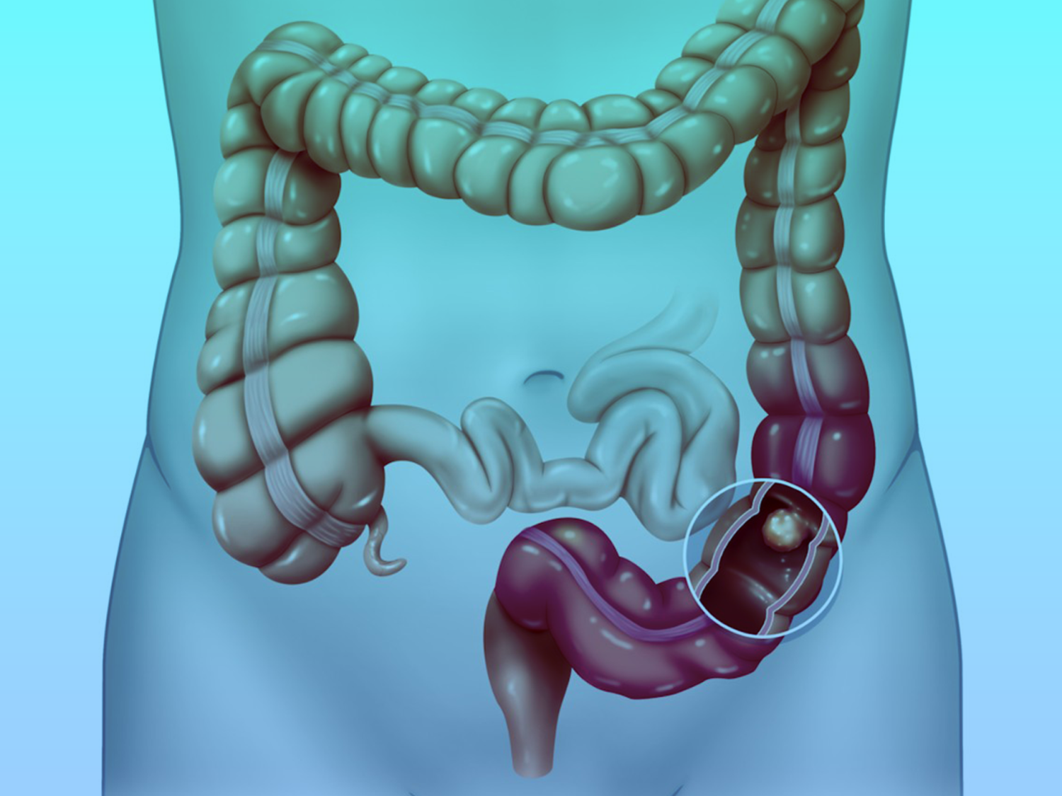 استصال-القولون