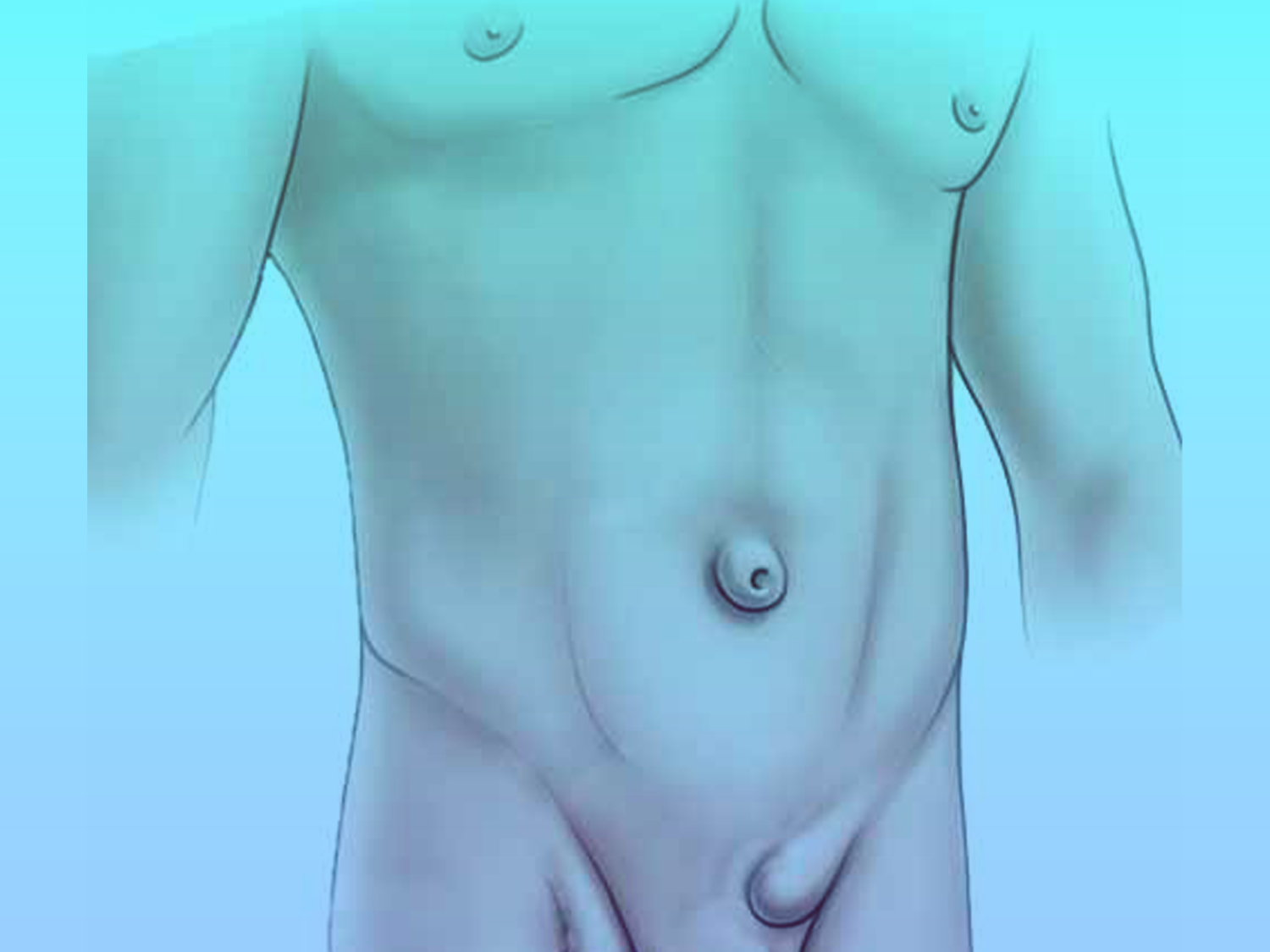 الفتق-الاربي