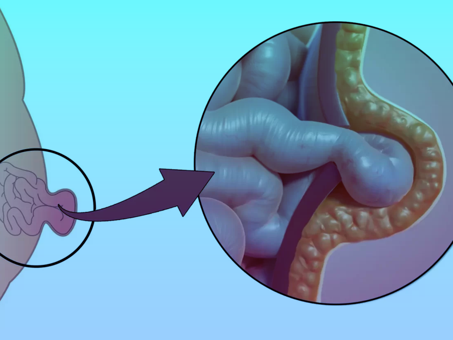 الفتق-السري
