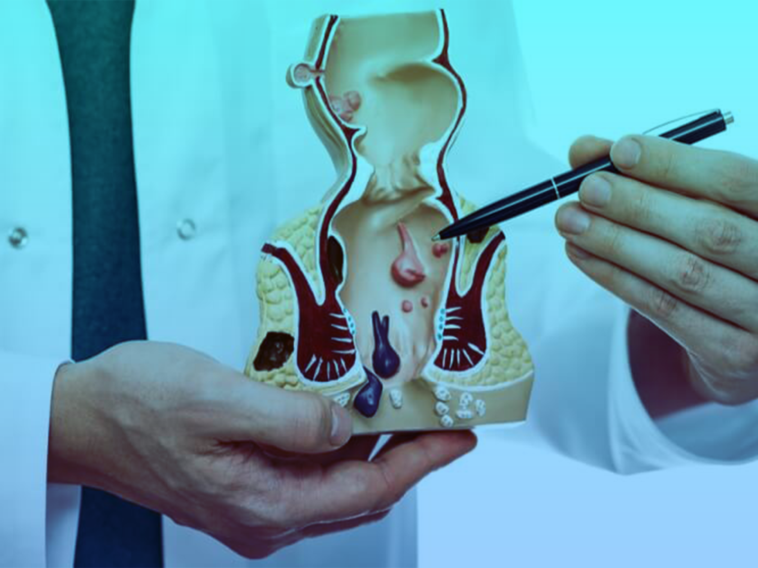 الناسور-الشرجي