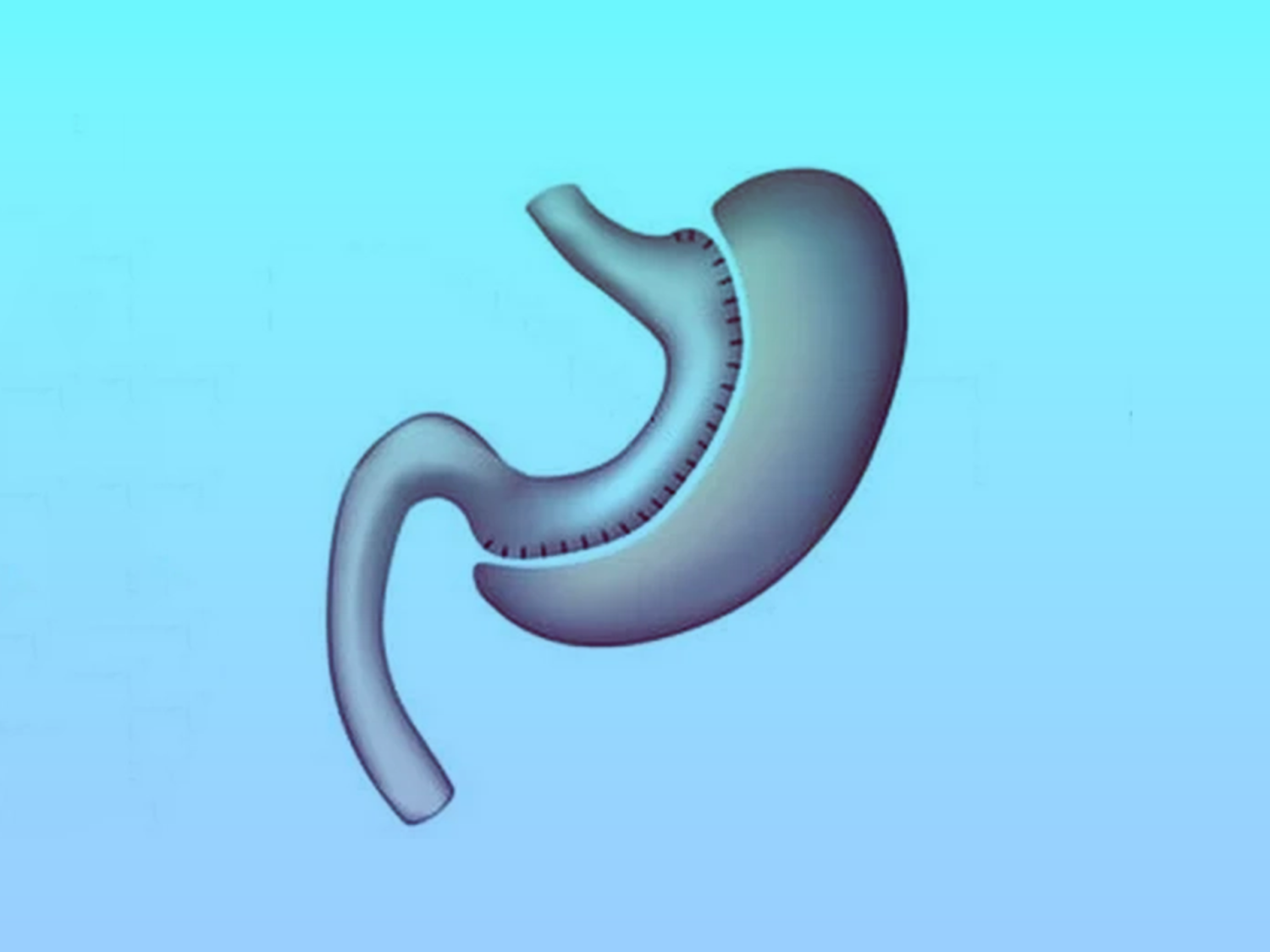 تكميم-المعده