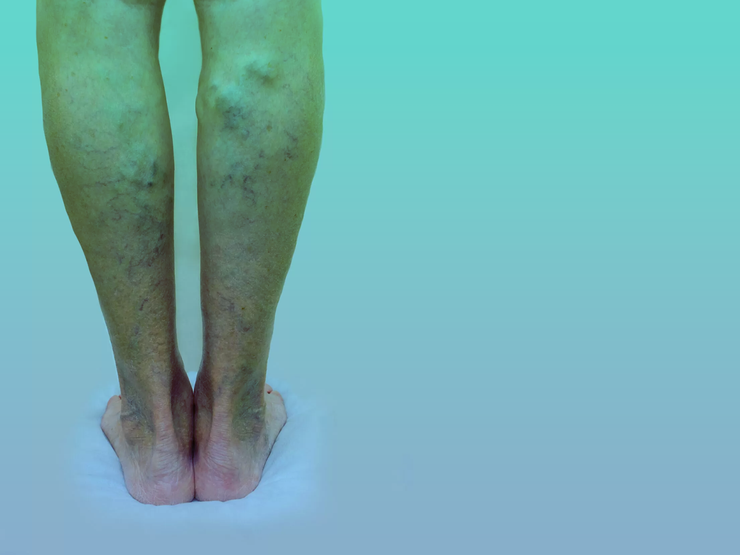 دوالي-الساقين