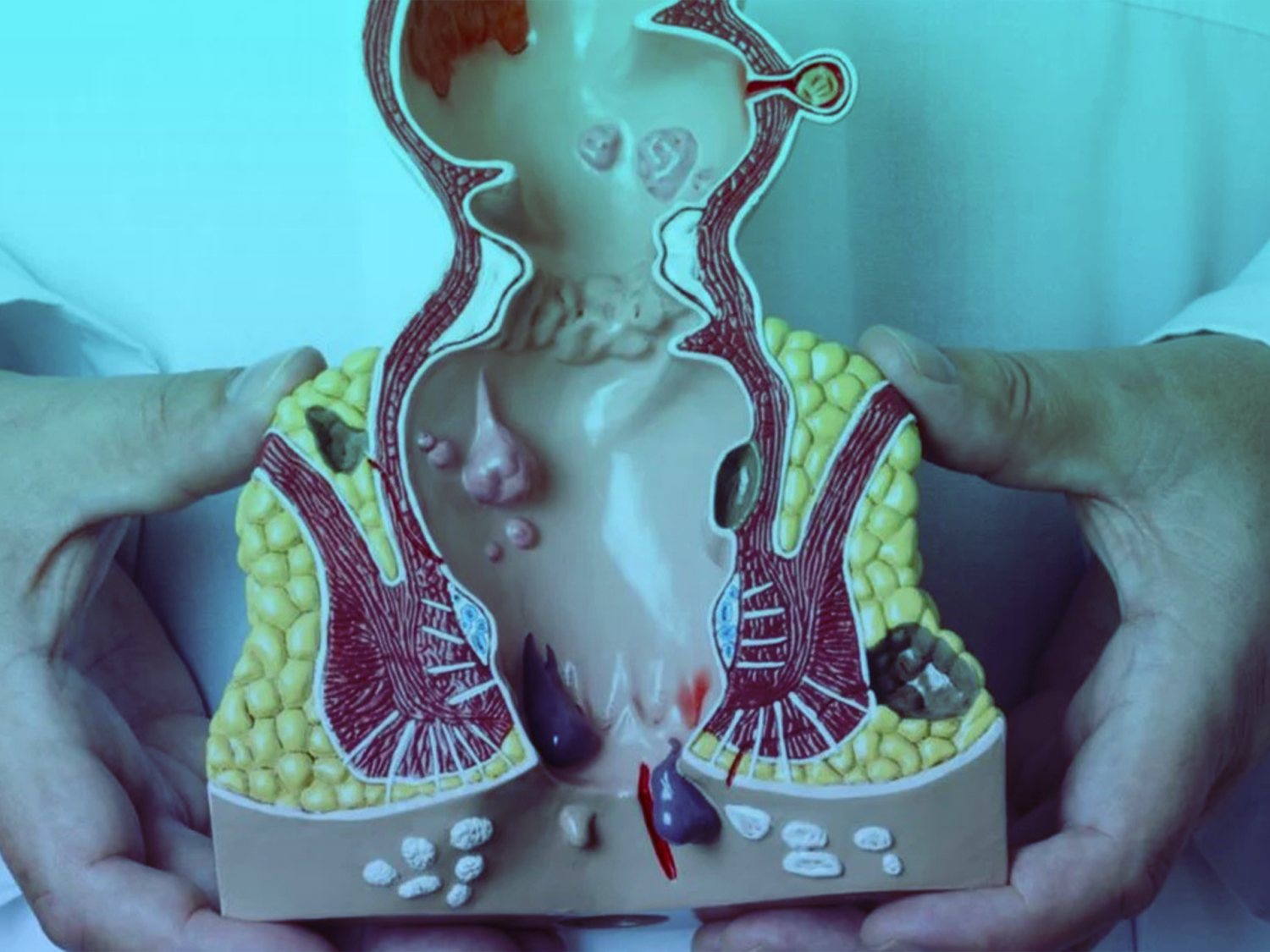 عمليه-البواسير