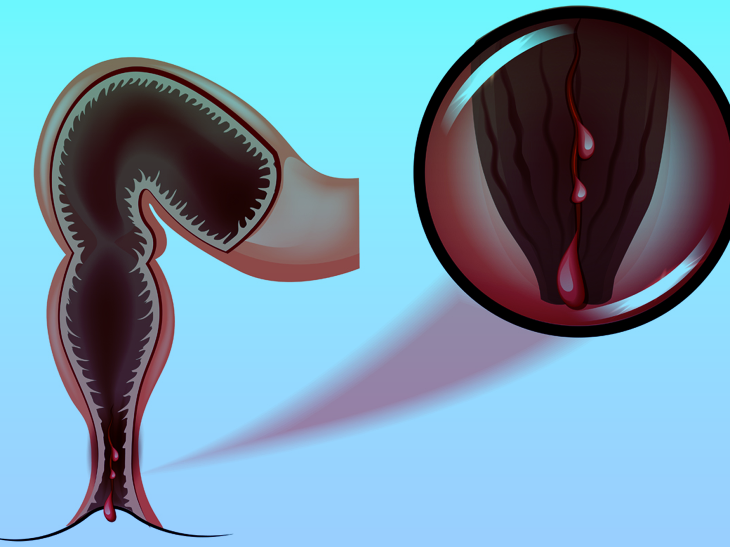 عمليه-الشرخ