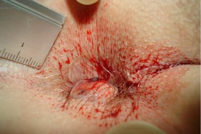 hemorrhoids